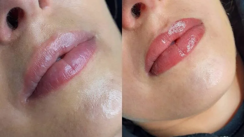 What is Lip Blush Treatment